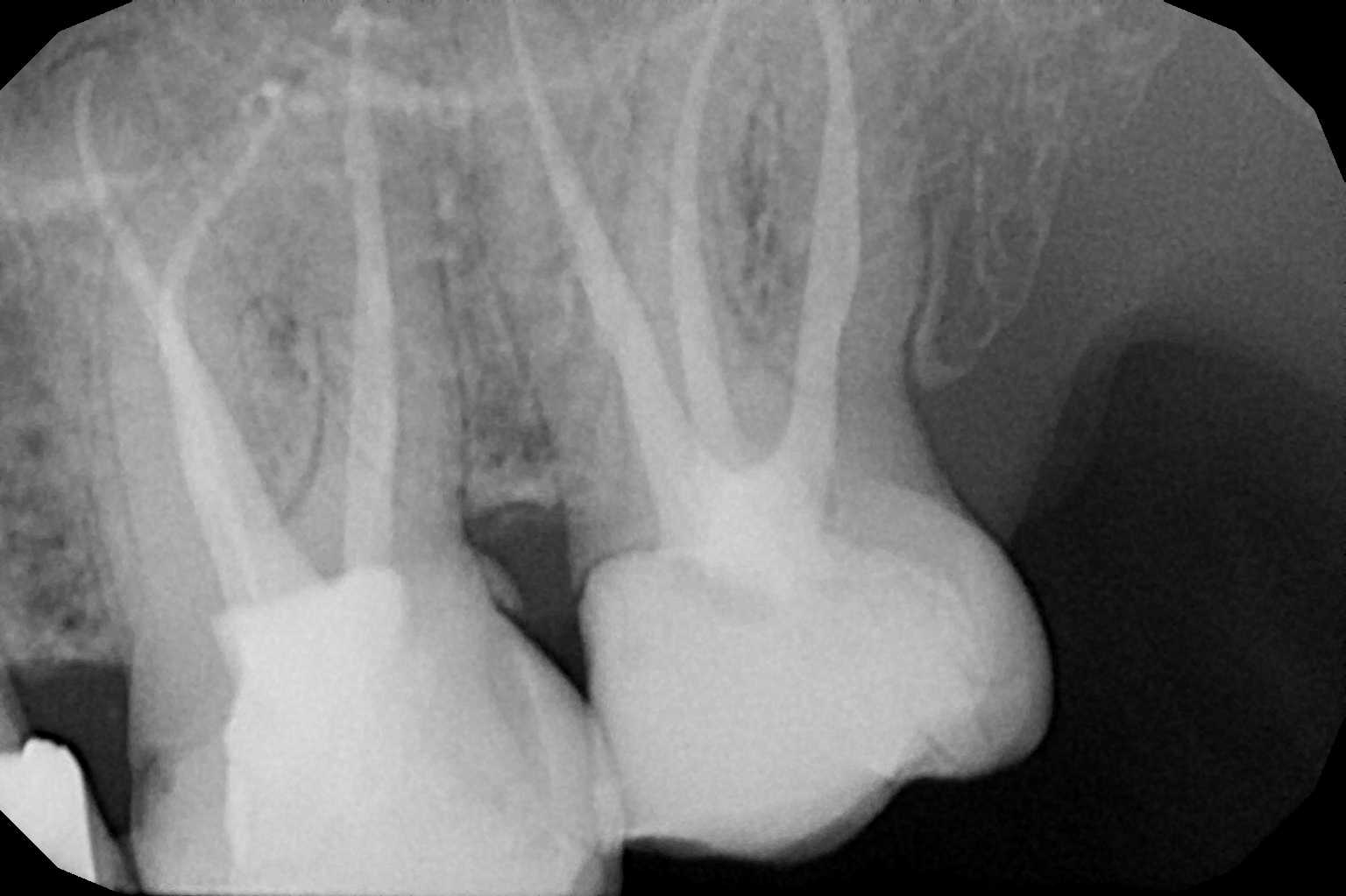 Caso di endodonzia dopo