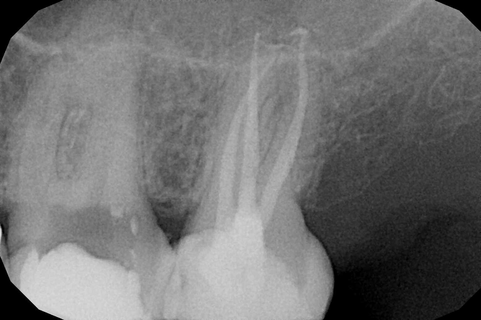 Caso di endodonzia prima